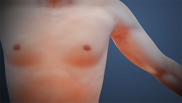 TAL Device streamlines subcutaneous tunneled catheter placement